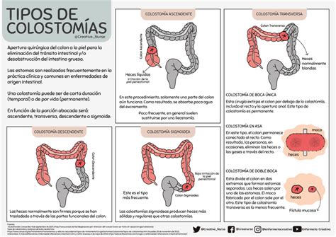 colostomía sin dolor.